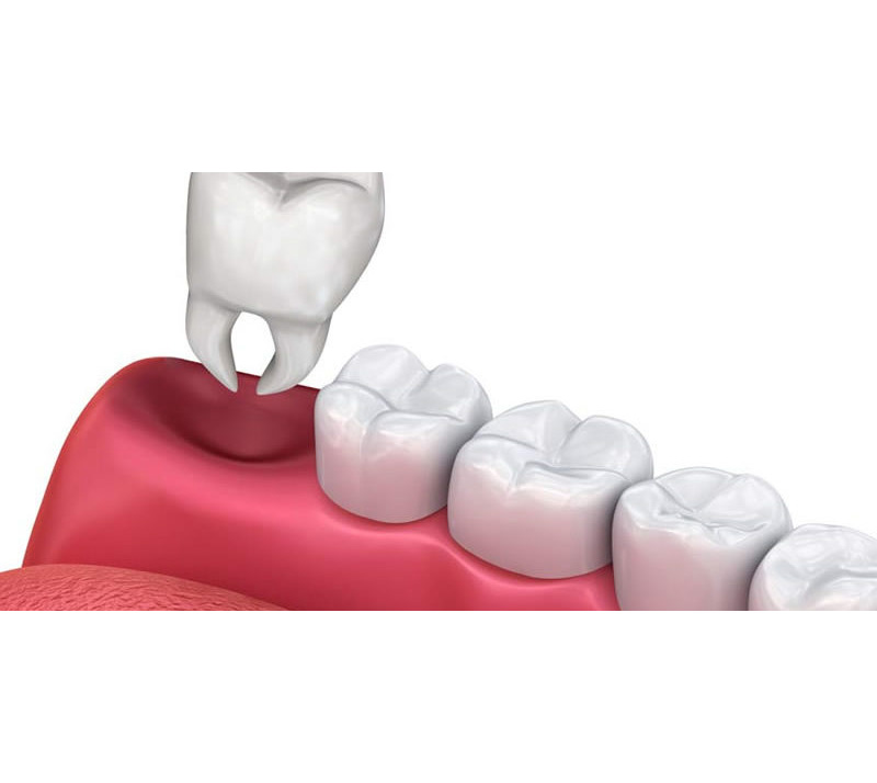 teeth extractions in shawnessy