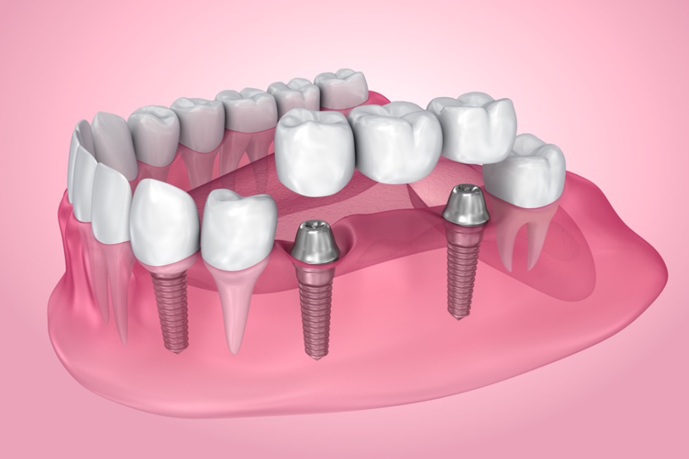 deciding-between-dental-bridges-and-dental-crowns-ask-your-dentist-these-questions