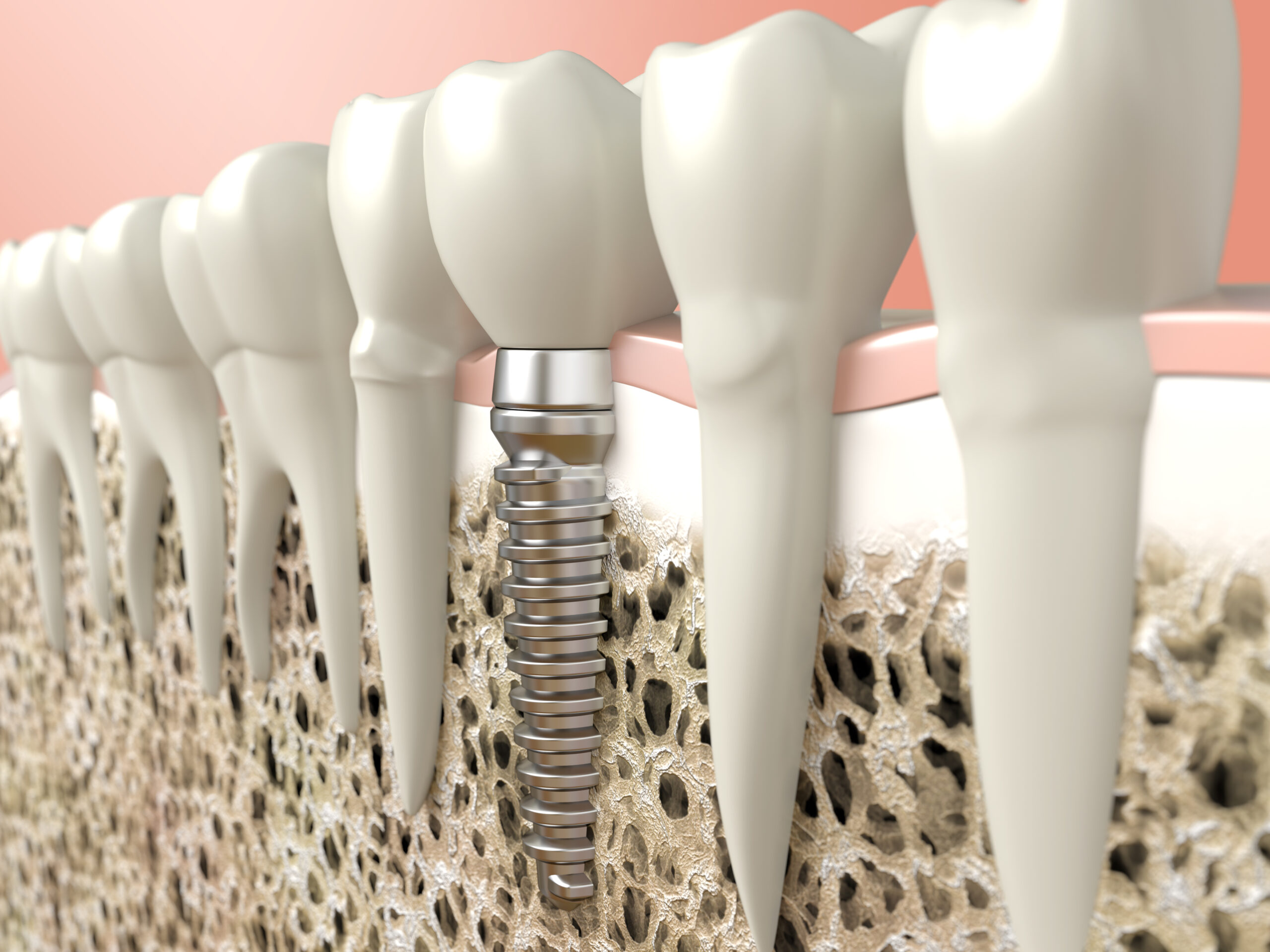 dental implants in shawnessy