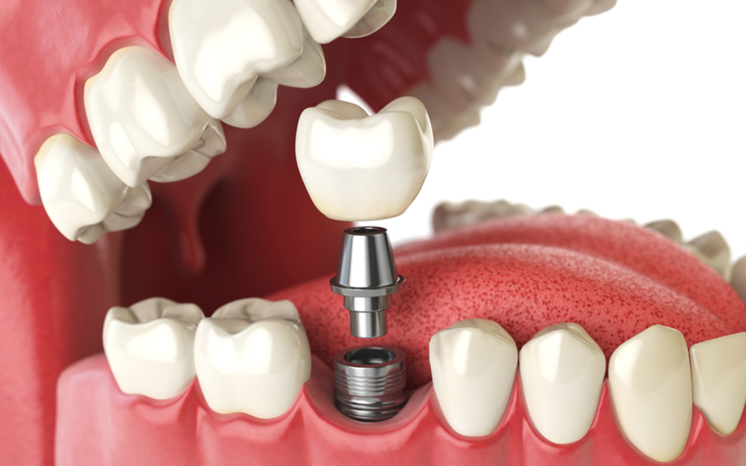 5 Reasons You Should Choose Dental Implants
